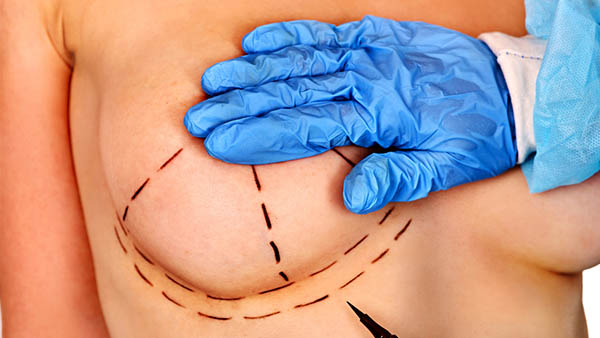 Docteur Robert Zerbib chirurgien Paris 16 75116 75016 Seins Prothese mammaire