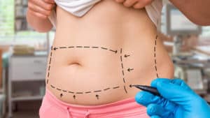 Docteur Robert Zerbib chirurgien Paris 16 75116 75016 Silhouette Abdominoplastie