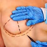 docteur robert zerbib chirurgie plastique chirurgien esthetique paris 16 75116 chirurgie esthetique des seins paris augmentation mammaire protheses mammaire