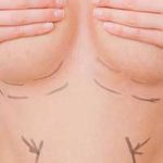 docteur robert zerbib chirurgie plastique chirurgien esthetique paris 16 75116 chirurgie esthetique des seins paris lifting des seins ptose mammaire