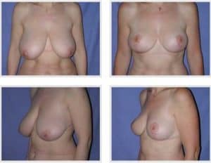 docteur robert zerbib chirurgie plastique chirurgien esthetique paris 16 75116 chirurgie esthetique des seins reduction mammaire pour hypertrophie mammaire plastie mammaire de reduction 7