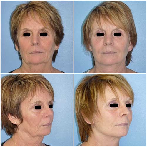 docteur robert zerbib chirurgie plastique chirurgien esthetique paris 16 75116 lifting du visage lifting cervico-facial lifting centro-facial paris 16 1