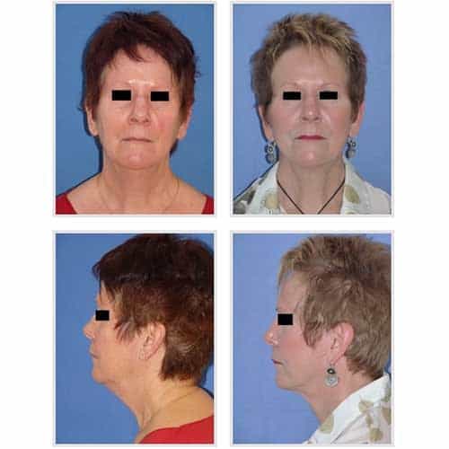 docteur robert zerbib chirurgie plastique chirurgien esthetique paris 16 75116 lifting du visage lifting cervico-facial lifting centro-facial paris 16 7