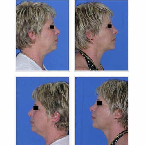docteur robert zerbib chirurgie plastique chirurgien esthetique paris 16 75116 liposuccion visage 3