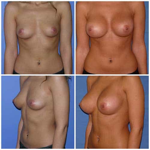 dr robert zerbib chirurgie plastique chirurgien esthetique paris 16 75116 chirurgie esthetique des seins augmentation mammaire par protheses mammaires paris 16 1