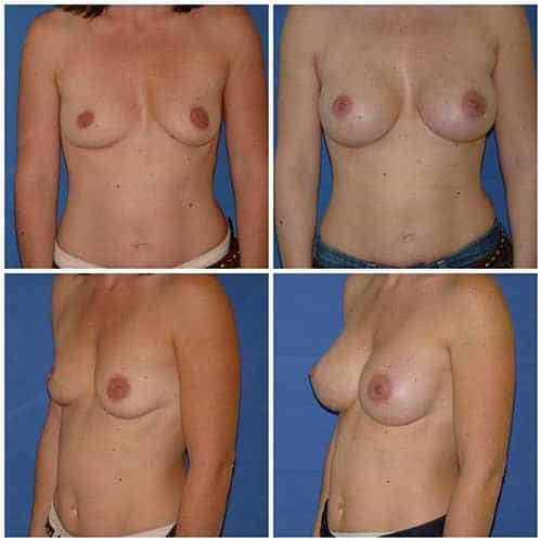 dr robert zerbib chirurgie plastique chirurgien esthetique paris 16 75116 chirurgie esthetique des seins augmentation mammaire par protheses mammaires paris 16 14