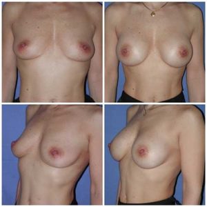 dr robert zerbib chirurgie plastique chirurgien esthetique paris 16 75116 chirurgie esthetique des seins augmentation mammaire par protheses mammaires paris 16 19
