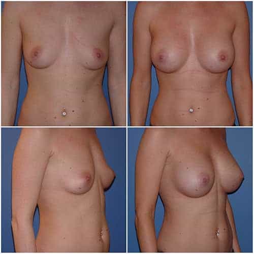 dr robert zerbib chirurgie plastique chirurgien esthetique paris 16 75116 chirurgie esthetique des seins augmentation mammaire par protheses mammaires paris 16 22