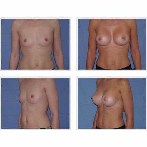 dr robert zerbib chirurgie plastique chirurgien esthetique paris 16 75116 chirurgie esthetique des seins augmentation mammaire par protheses mammaires paris 16 23