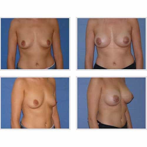 dr robert zerbib chirurgie plastique chirurgien esthetique paris 16 75116 chirurgie esthetique des seins augmentation mammaire par protheses mammaires paris 16 24