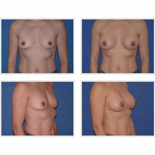dr robert zerbib chirurgie plastique chirurgien esthetique paris 16 75116 chirurgie esthetique des seins augmentation mammaire par protheses mammaires paris 16 28