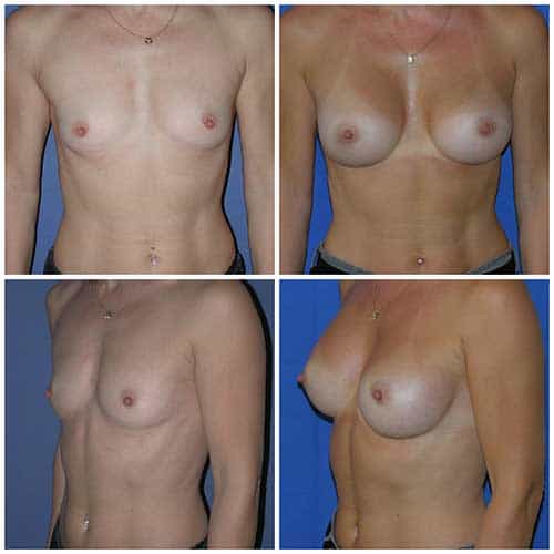 dr robert zerbib chirurgie plastique chirurgien esthetique paris 16 75116 chirurgie esthetique des seins augmentation mammaire par protheses mammaires paris 16 3