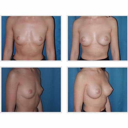 dr robert zerbib chirurgie plastique chirurgien esthetique paris 16 75116 chirurgie esthetique des seins augmentation mammaire par protheses mammaires paris 16 30