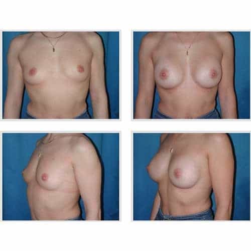 dr robert zerbib chirurgie plastique chirurgien esthetique paris 16 75116 chirurgie esthetique des seins augmentation mammaire par protheses mammaires paris 16 33
