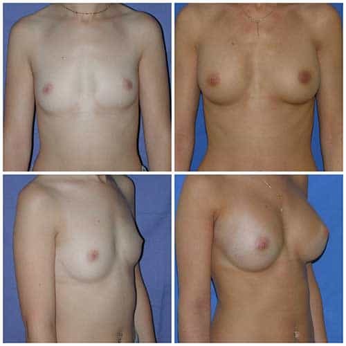 dr robert zerbib chirurgie plastique chirurgien esthetique paris 16 75116 chirurgie esthetique des seins augmentation mammaire par protheses mammaires paris 16 4