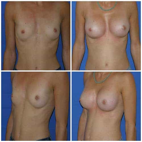 dr robert zerbib chirurgie plastique chirurgien esthetique paris 16 75116 chirurgie esthetique des seins augmentation mammaire par protheses mammaires paris 16 8