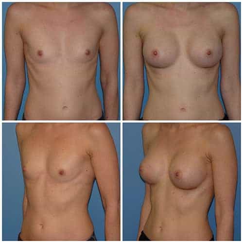 dr robert zerbib chirurgie plastique chirurgien esthetique paris 16 75116 chirurgie esthetique des seins augmentation mammaire par protheses mammaires paris 16 9