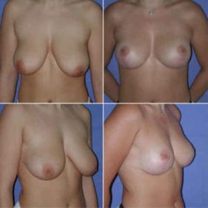 dr zerbib chirurgie plastique chirurgien esthetique paris 16 75116 seine et marne lifting mammaire seins qui tombent 12