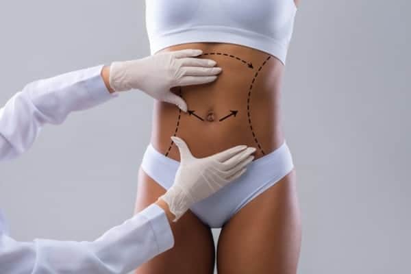plastie abdominale plastie abdominale prix plastie abdominale avant apres docteur robert zerbib chirurgien paris 16